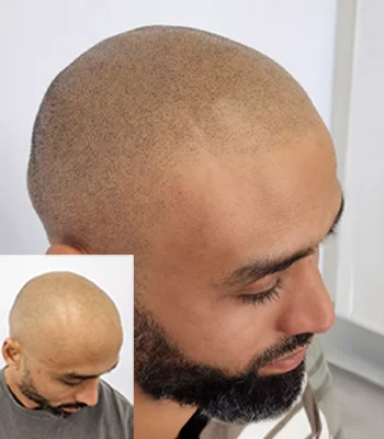 scalp-micropigmentation-mens-hair-loss-melbourne