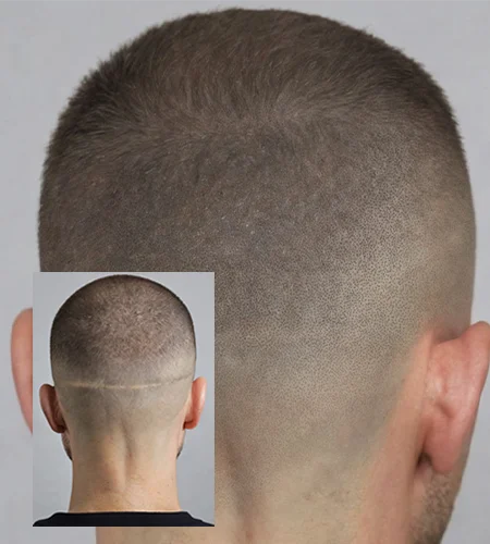 scalp-micropigmentation-melbourne-scar-camouflage-fue-fut-hair-transplant