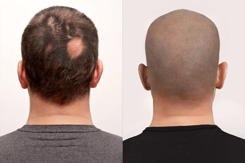 scalp-micropigmentation-for-alopecia