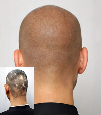 scalp-micropigmentation-melbourne-alopecia