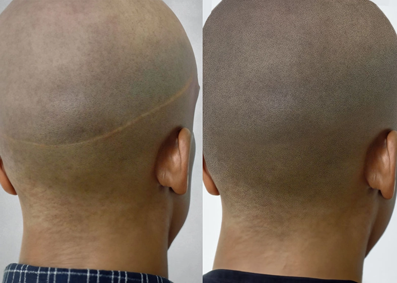 scalp-micropigmentation-scar-camouflage