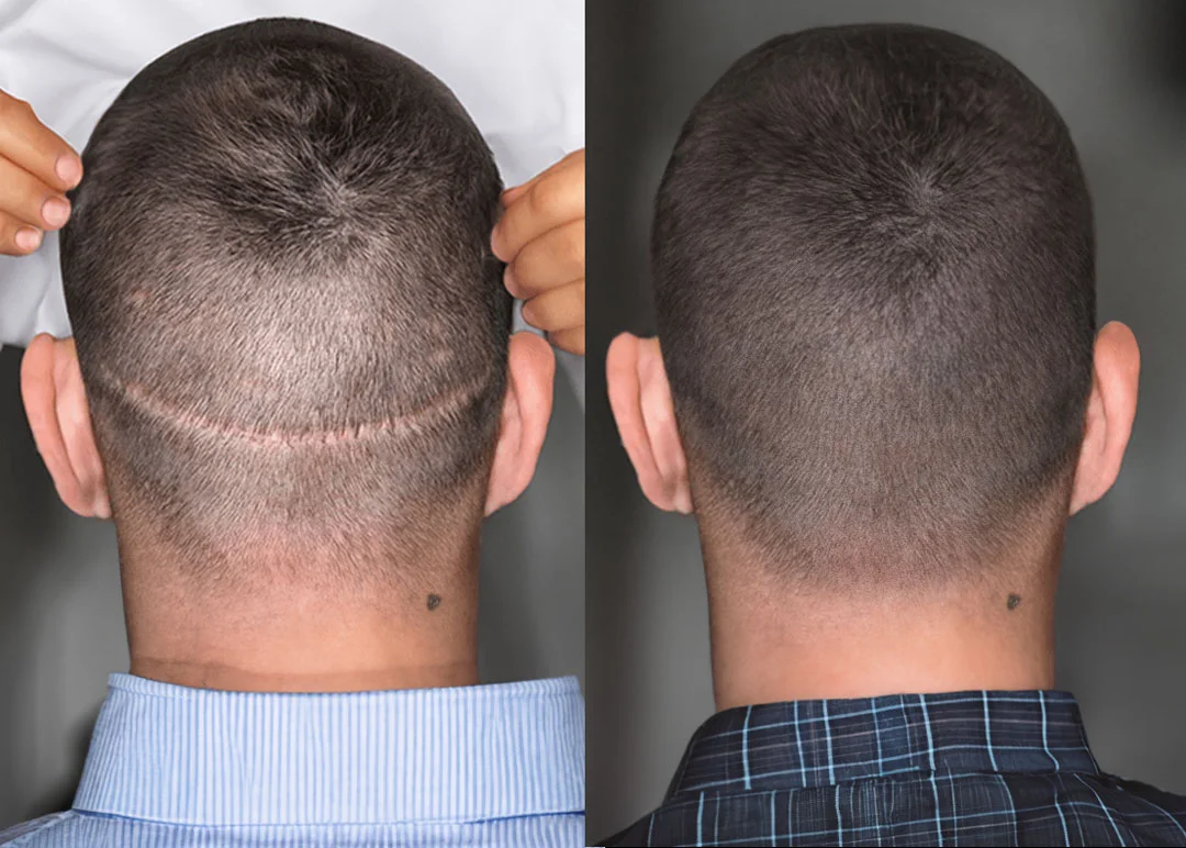 FUE FUT Transplant Scar Camouflage - SMP Melbourne