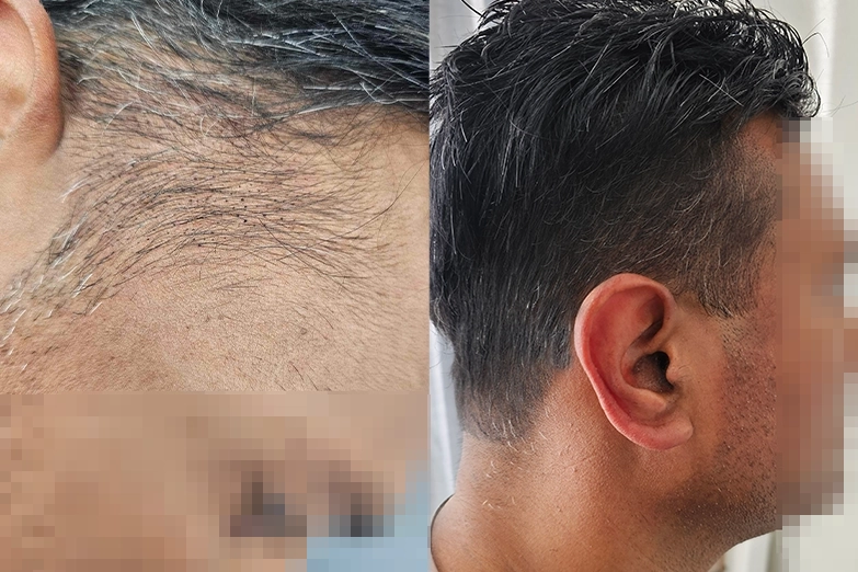 scalp-micropigmentation-hair-replacement-system-unit