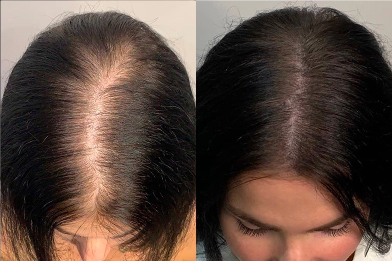 smp-micropigmentation-for-women